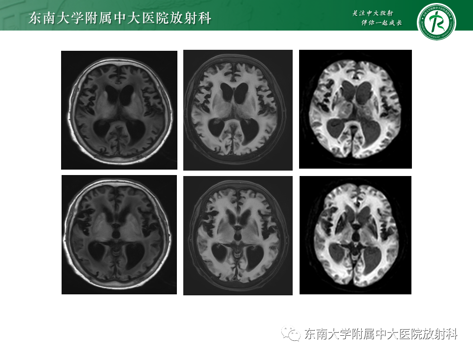 影像PPT - 【PPT】肝性脑病的影像学表现-31