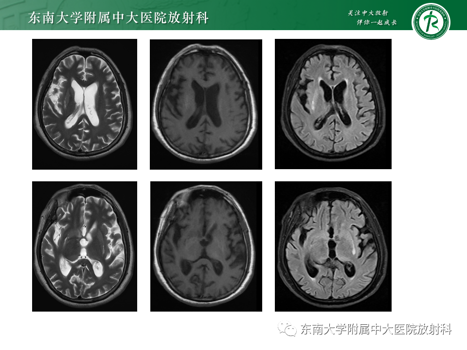 影像PPT - 【PPT】肝性脑病的影像学表现-37