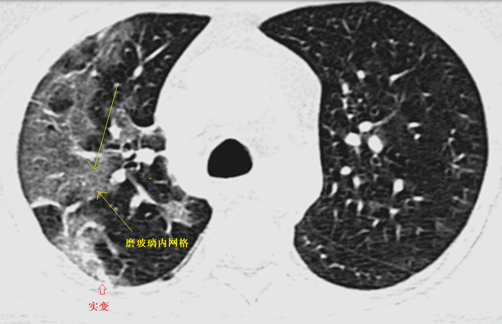影像PPT - 新冠肺炎典型影像学诊断与鉴别诊断-2 影像PPT - 新冠肺炎典型影像学诊断与鉴别诊断-2