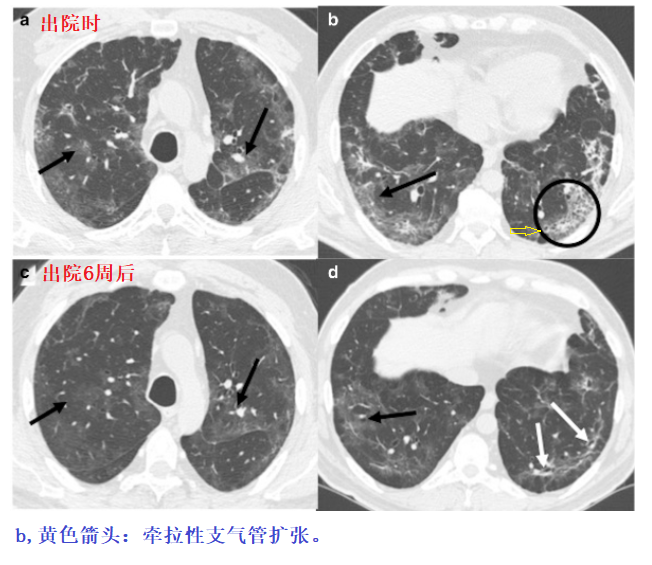 影像PPT - 新冠肺炎典型影像学诊断与鉴别诊断-9 影像PPT - 新冠肺炎典型影像学诊断与鉴别诊断-9