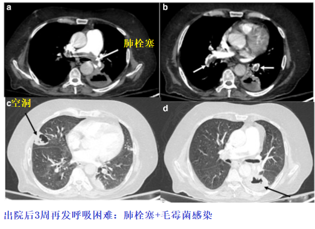 影像PPT - 新冠肺炎典型影像学诊断与鉴别诊断-18 影像PPT - 新冠肺炎典型影像学诊断与鉴别诊断-18