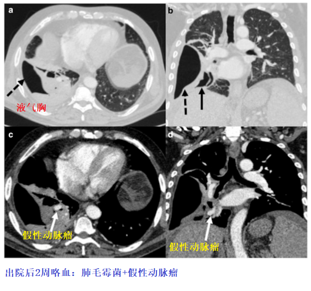 影像PPT - 新冠肺炎典型影像学诊断与鉴别诊断-19 影像PPT - 新冠肺炎典型影像学诊断与鉴别诊断-19