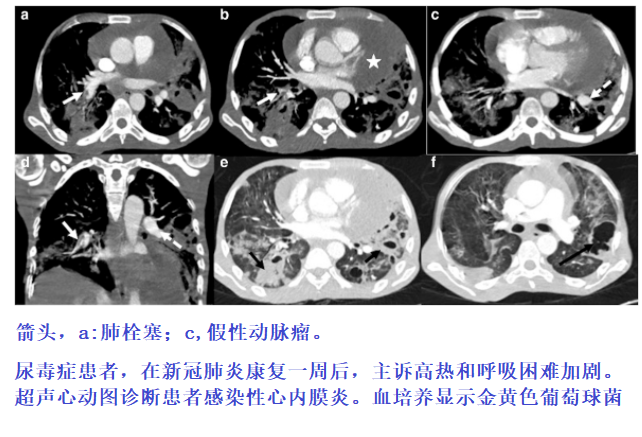 影像PPT - 新冠肺炎典型影像学诊断与鉴别诊断-22 影像PPT - 新冠肺炎典型影像学诊断与鉴别诊断-22