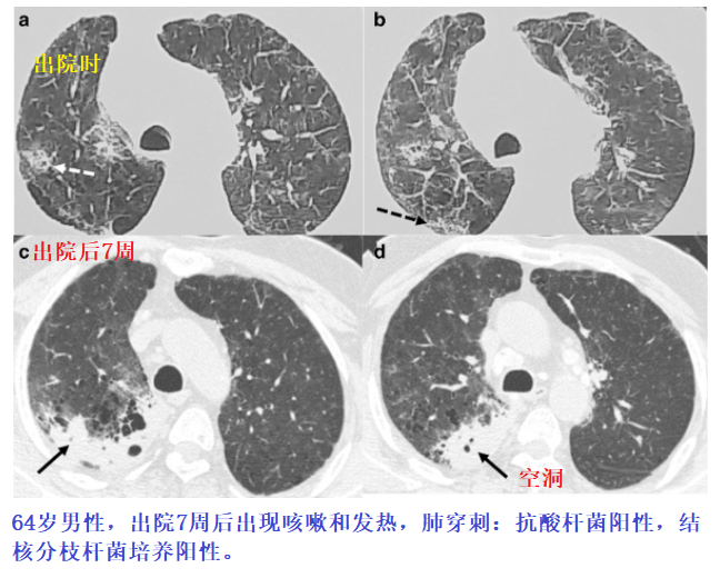 影像PPT - 新冠肺炎典型影像学诊断与鉴别诊断-23 影像PPT - 新冠肺炎典型影像学诊断与鉴别诊断-23
