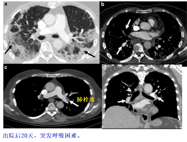 影像PPT - 新冠肺炎典型影像学诊断与鉴别诊断-25 影像PPT - 新冠肺炎典型影像学诊断与鉴别诊断-25