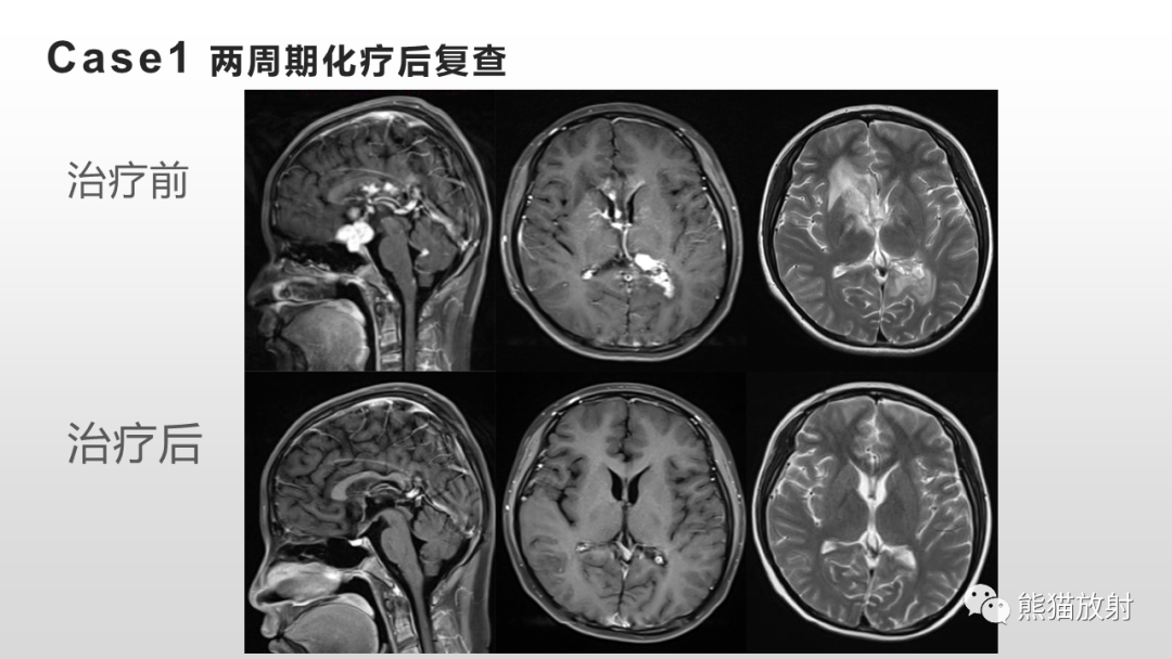 影像PPT - 【PPT】颅内生殖细胞瘤-11