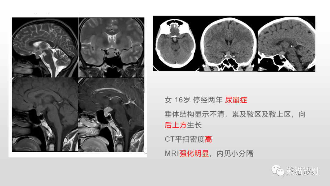 影像PPT - 【PPT】颅内生殖细胞瘤-17