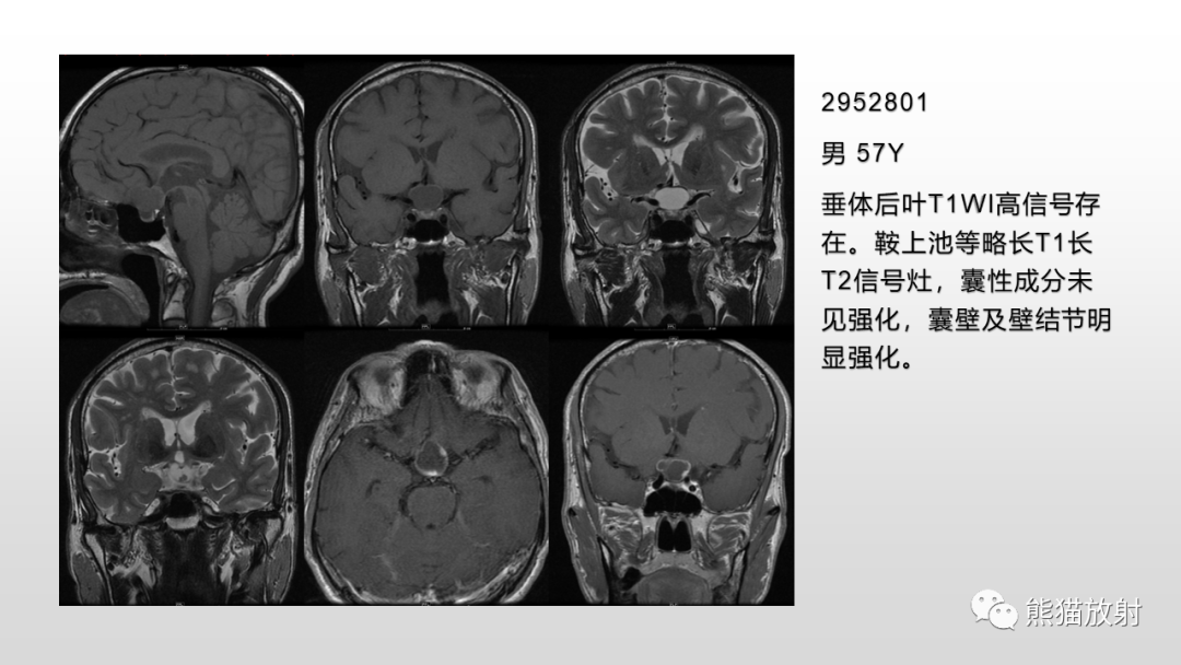 影像PPT - 【PPT】颅内生殖细胞瘤-19