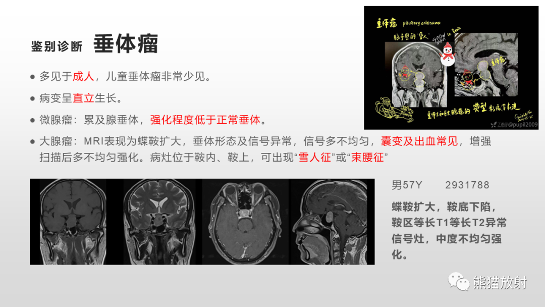 影像PPT - 【PPT】颅内生殖细胞瘤-20