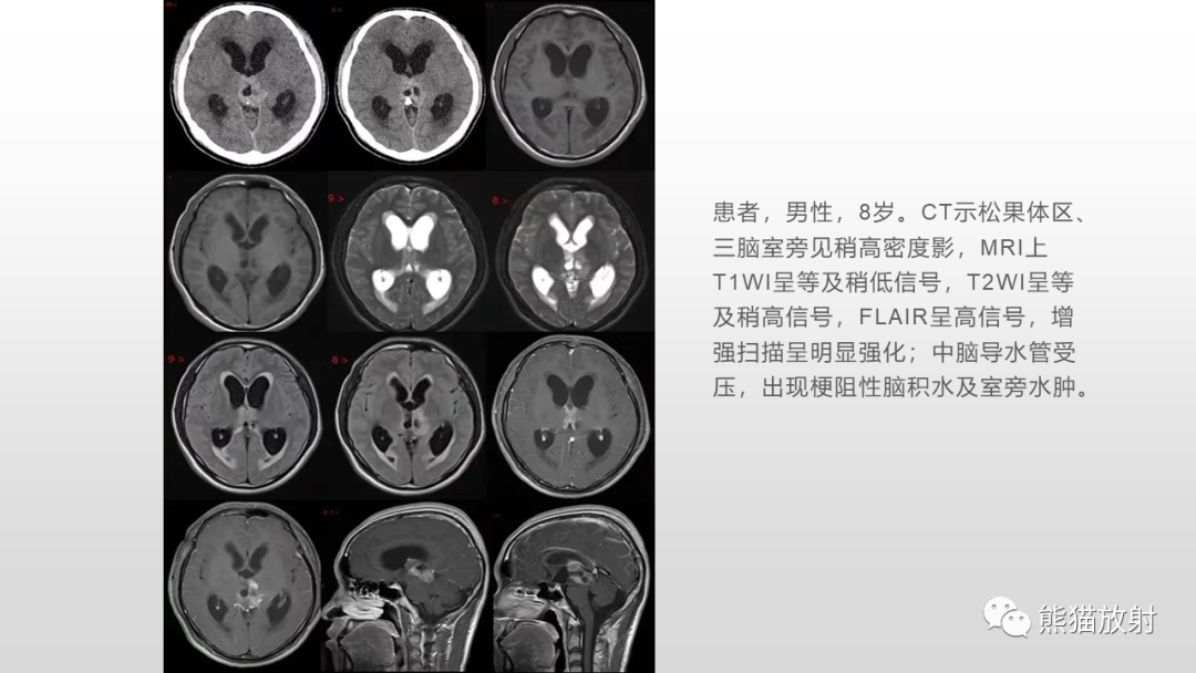 影像PPT - 【PPT】颅内生殖细胞瘤-23