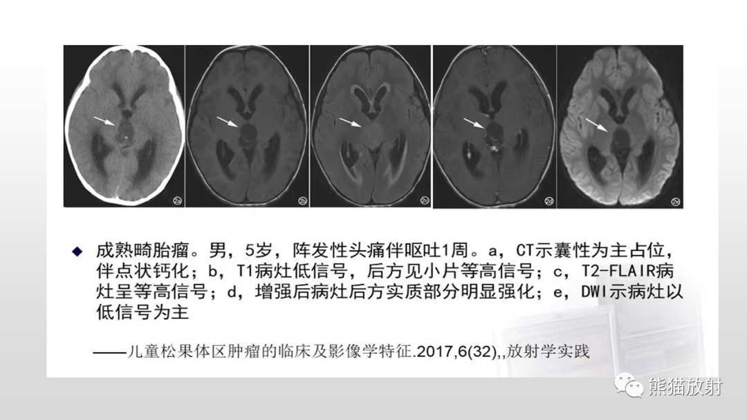 影像PPT - 【PPT】颅内生殖细胞瘤-27
