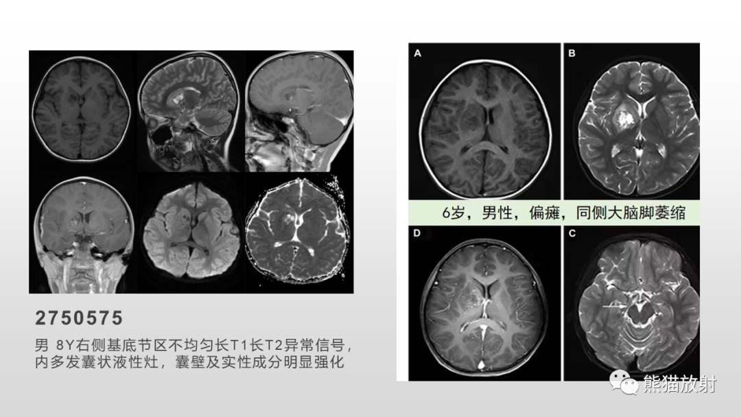 影像PPT - 【PPT】颅内生殖细胞瘤-29
