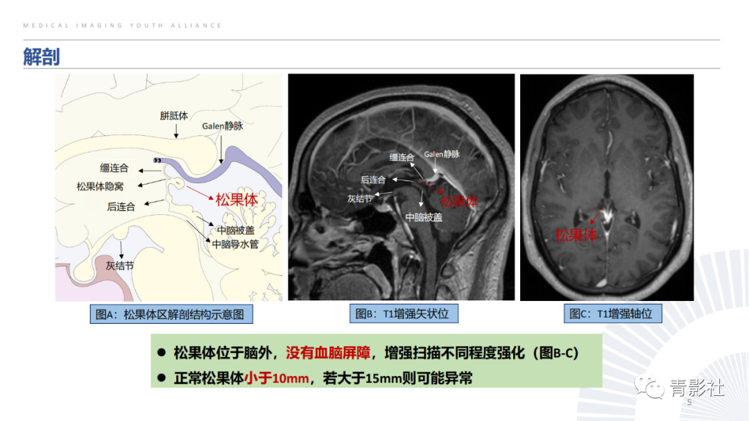 影像PPT - 【PPT】松果体区肿瘤性病变影像诊断-5