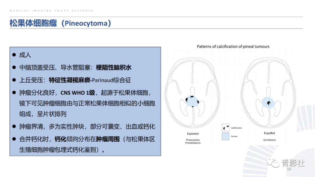 影像PPT - 【PPT】松果体区肿瘤性病变影像诊断-10