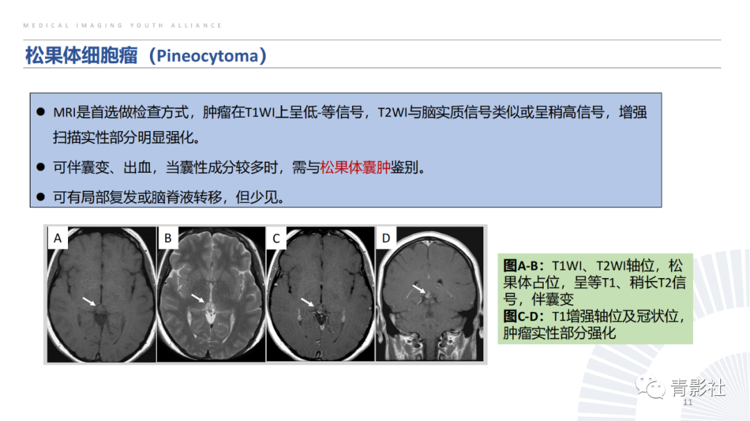 影像PPT - 【PPT】松果体区肿瘤性病变影像诊断-11