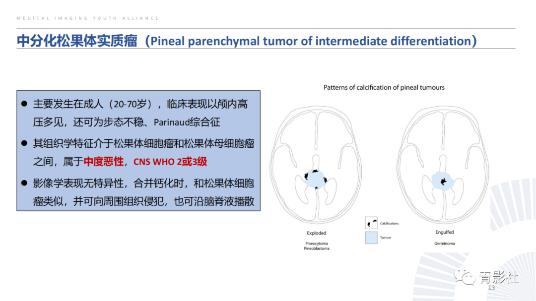 影像PPT - 【PPT】松果体区肿瘤性病变影像诊断-13