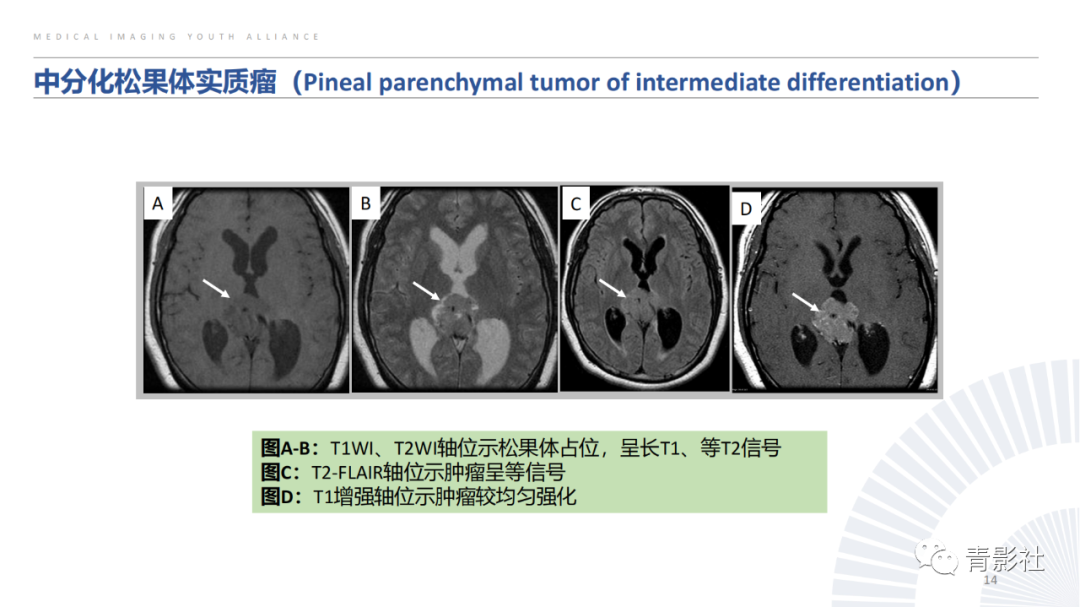 影像PPT - 【PPT】松果体区肿瘤性病变影像诊断-14