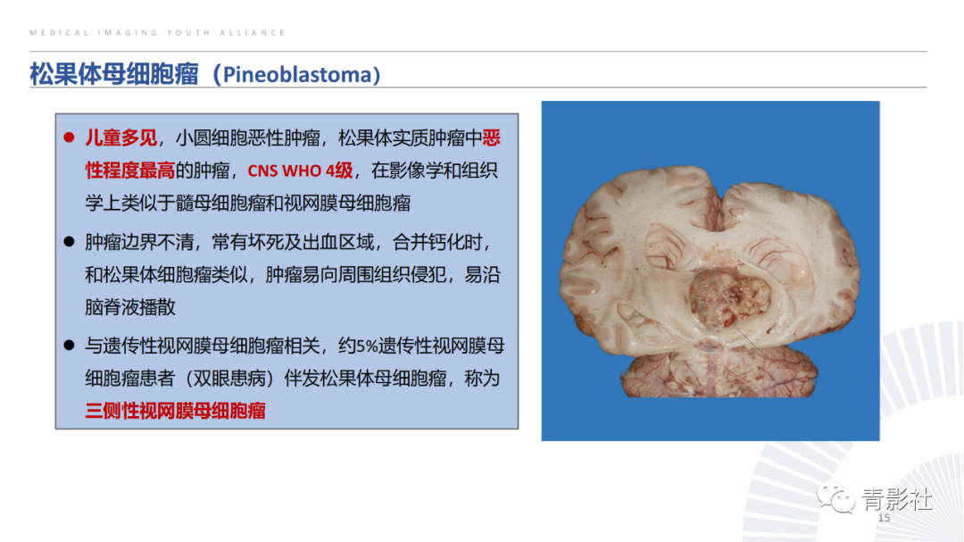 影像PPT - 【PPT】松果体区肿瘤性病变影像诊断-15