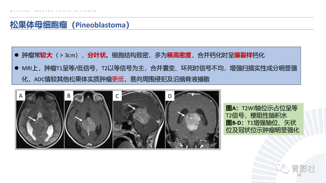 影像PPT - 【PPT】松果体区肿瘤性病变影像诊断-16
