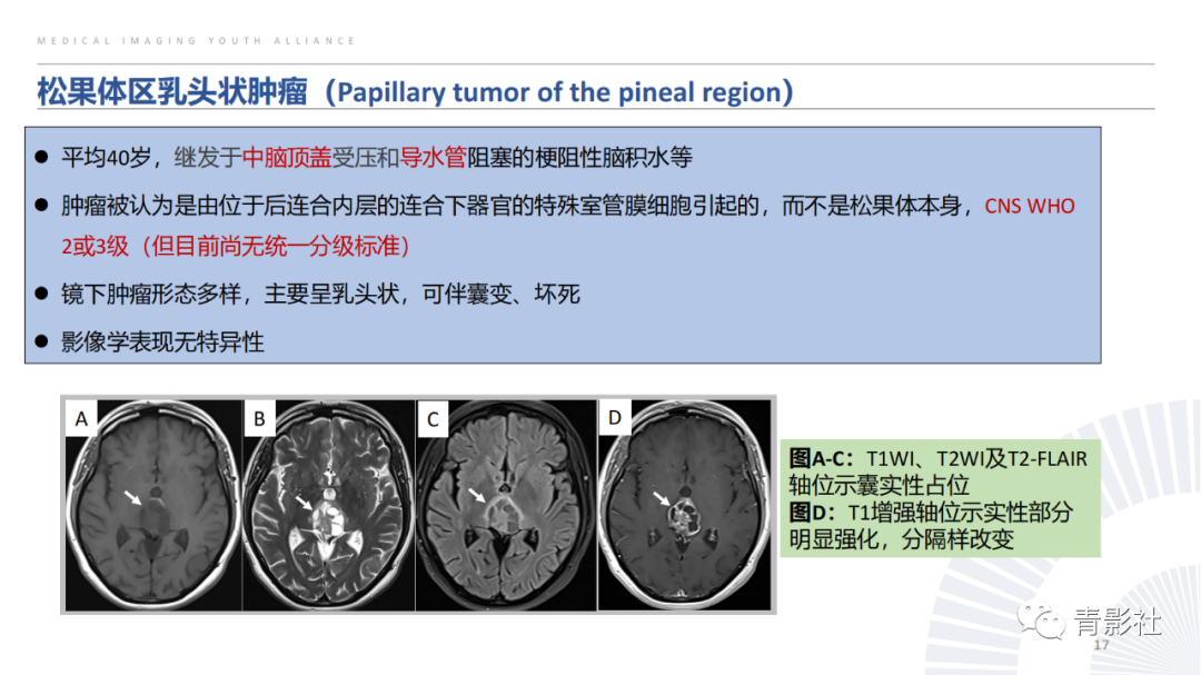 影像PPT - 【PPT】松果体区肿瘤性病变影像诊断-17
