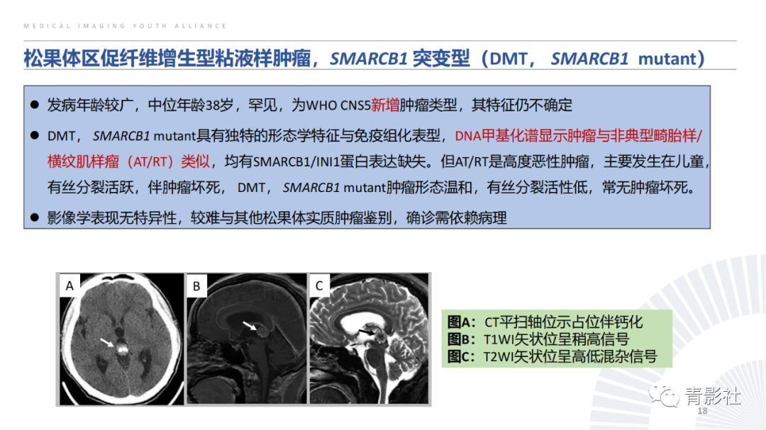 影像PPT - 【PPT】松果体区肿瘤性病变影像诊断-18