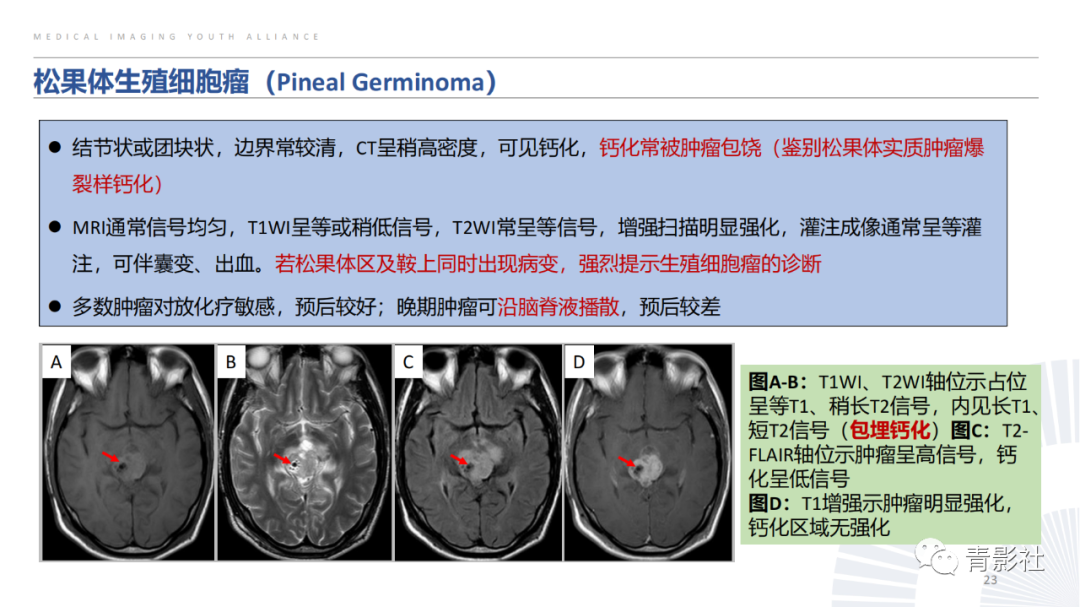 影像PPT - 【PPT】松果体区肿瘤性病变影像诊断-23