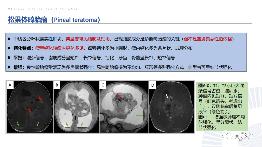 影像PPT - 【PPT】松果体区肿瘤性病变影像诊断-26