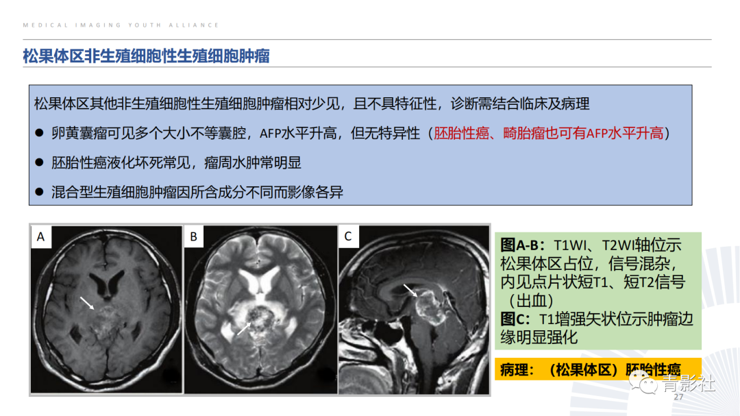影像PPT - 【PPT】松果体区肿瘤性病变影像诊断-27