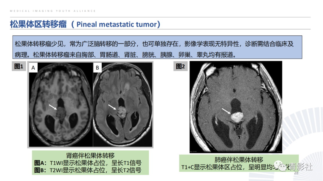 影像PPT - 【PPT】松果体区肿瘤性病变影像诊断-28