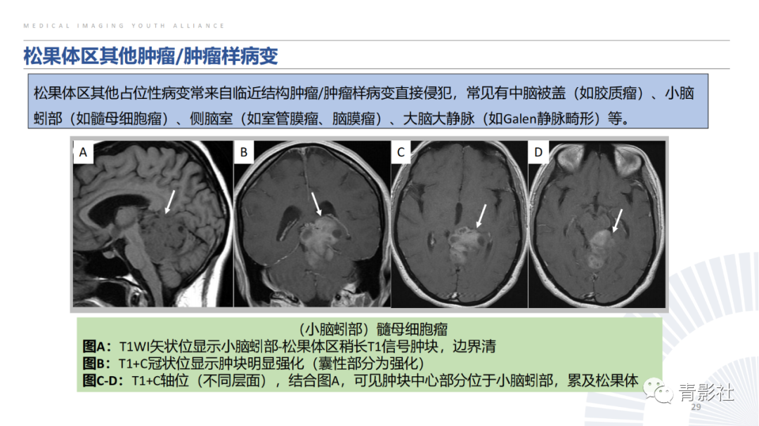 影像PPT - 【PPT】松果体区肿瘤性病变影像诊断-29