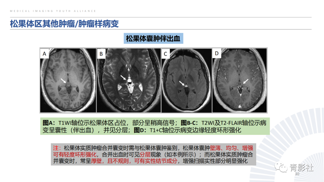 影像PPT - 【PPT】松果体区肿瘤性病变影像诊断-30