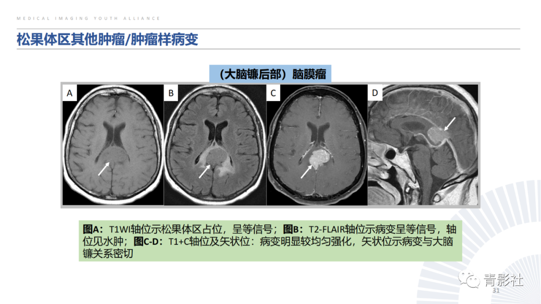 影像PPT - 【PPT】松果体区肿瘤性病变影像诊断-31