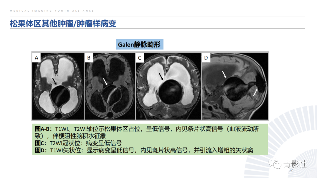 影像PPT - 【PPT】松果体区肿瘤性病变影像诊断-32