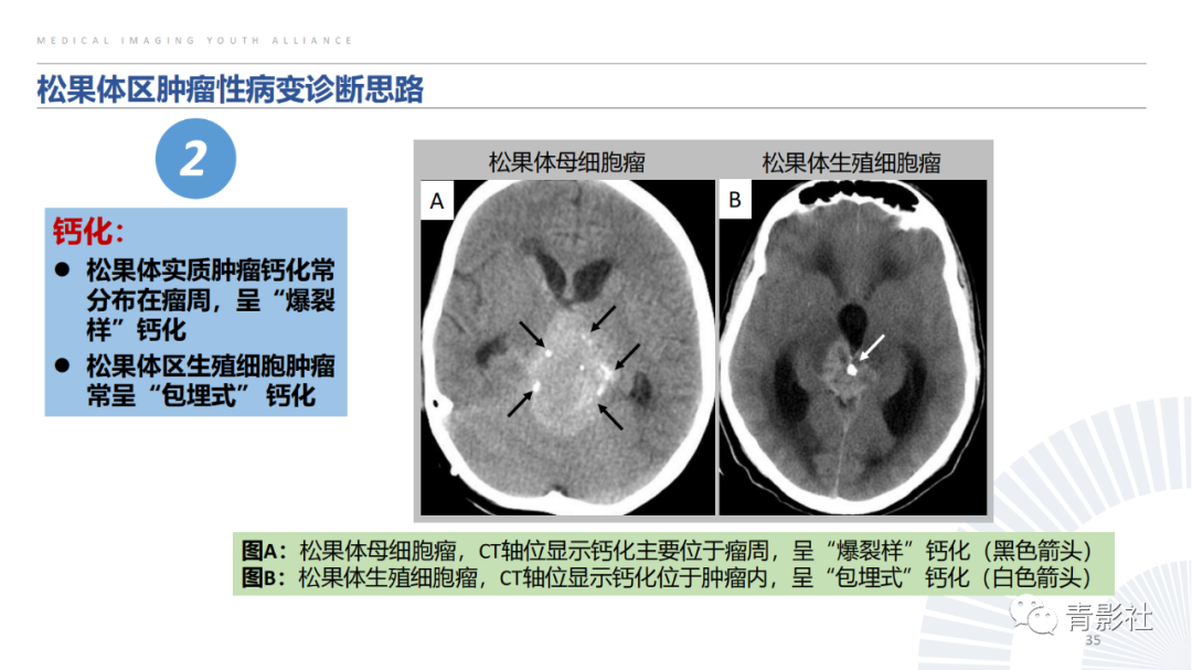 影像PPT - 【PPT】松果体区肿瘤性病变影像诊断-35