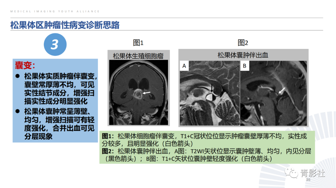 影像PPT - 【PPT】松果体区肿瘤性病变影像诊断-36