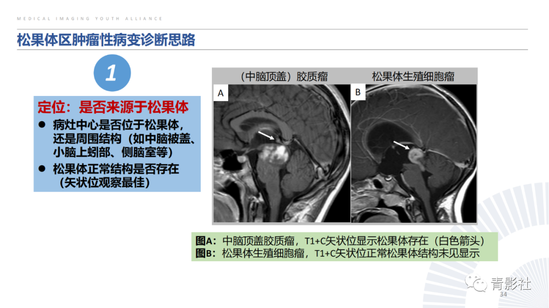 影像PPT - 【PPT】松果体区肿瘤性病变影像诊断-34