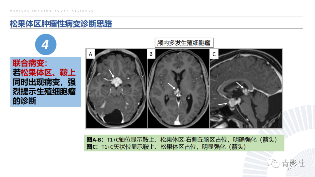 影像PPT - 【PPT】松果体区肿瘤性病变影像诊断-37