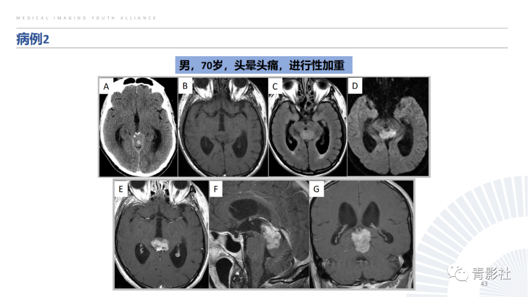 影像PPT - 【PPT】松果体区肿瘤性病变影像诊断-43