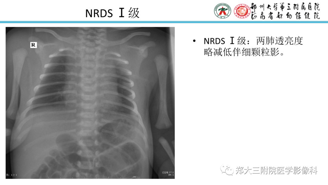 影像PPT - 【PPT】新生儿呼吸窘迫综合征床旁胸片诊断-9