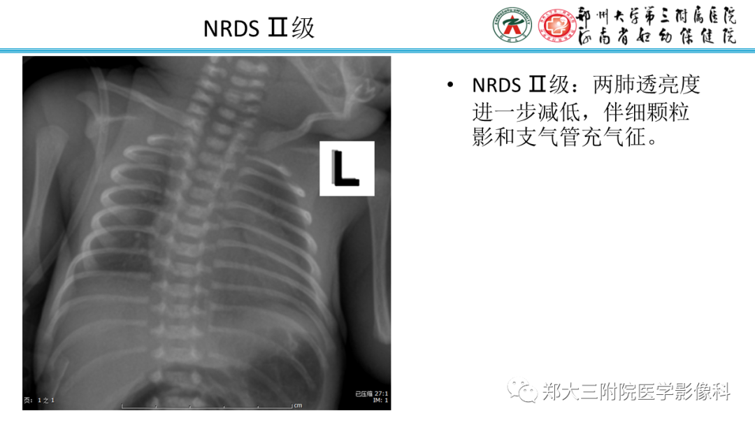 影像PPT - 【PPT】新生儿呼吸窘迫综合征床旁胸片诊断-10