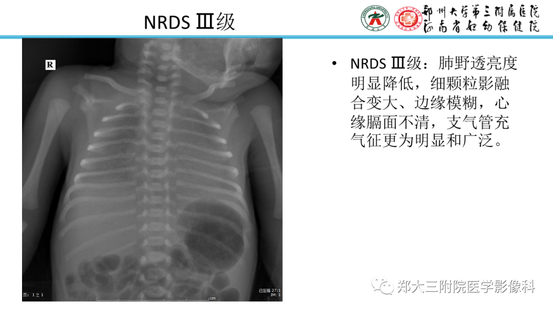 影像PPT - 【PPT】新生儿呼吸窘迫综合征床旁胸片诊断-11