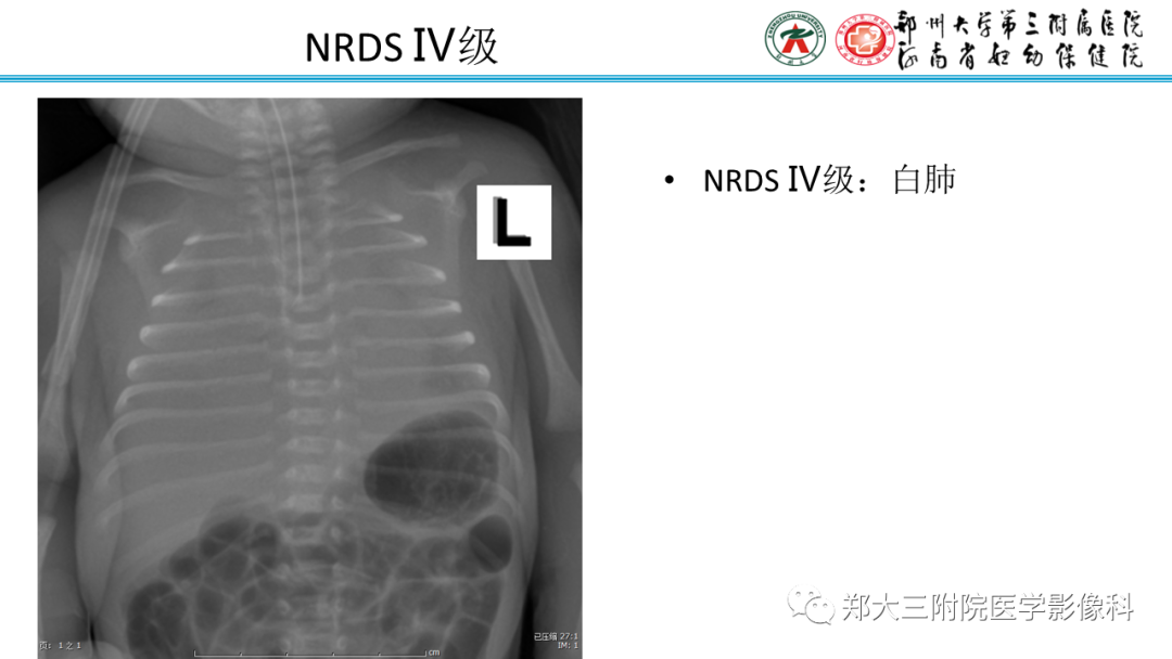 影像PPT - 【PPT】新生儿呼吸窘迫综合征床旁胸片诊断-12