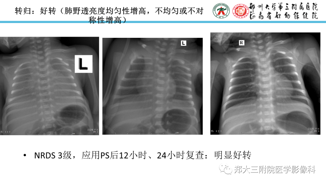 影像PPT - 【PPT】新生儿呼吸窘迫综合征床旁胸片诊断-13