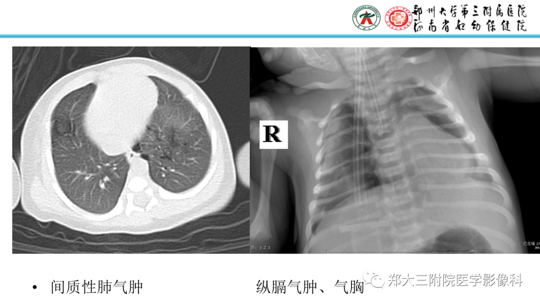 影像PPT - 【PPT】新生儿呼吸窘迫综合征床旁胸片诊断-15