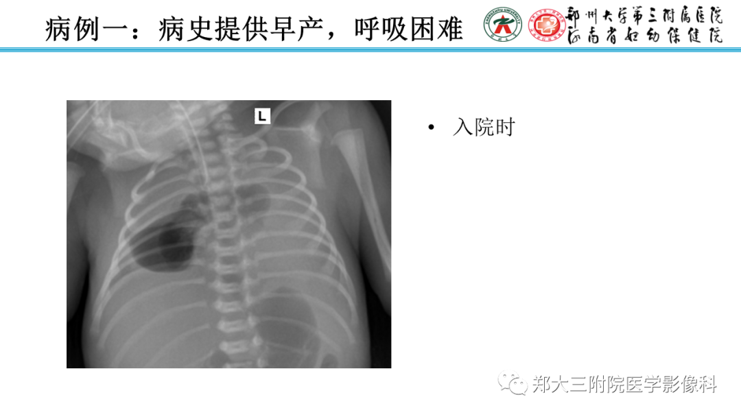 影像PPT - 【PPT】新生儿呼吸窘迫综合征床旁胸片诊断-16