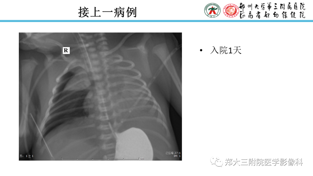 影像PPT - 【PPT】新生儿呼吸窘迫综合征床旁胸片诊断-17