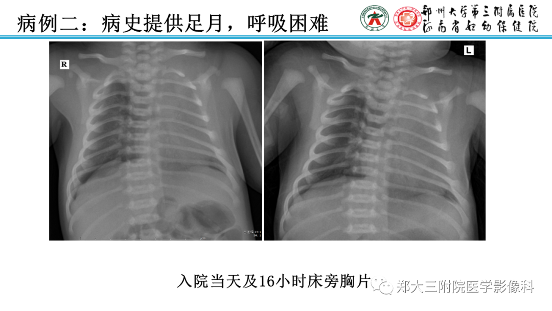 影像PPT - 【PPT】新生儿呼吸窘迫综合征床旁胸片诊断-18