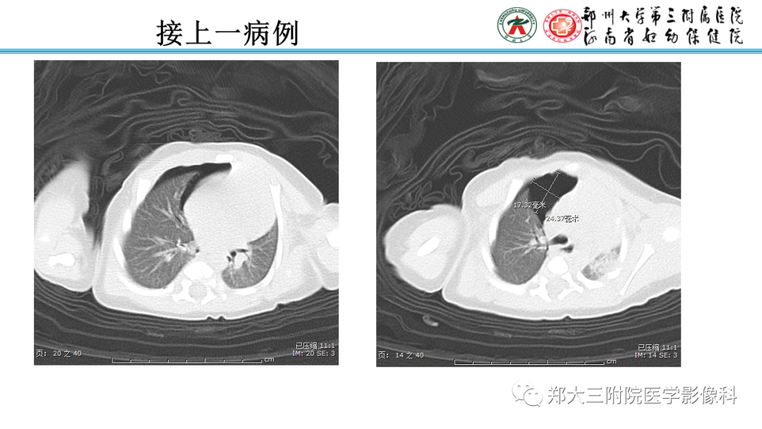 影像PPT - 【PPT】新生儿呼吸窘迫综合征床旁胸片诊断-19
