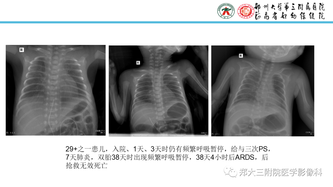 影像PPT - 【PPT】新生儿呼吸窘迫综合征床旁胸片诊断-21