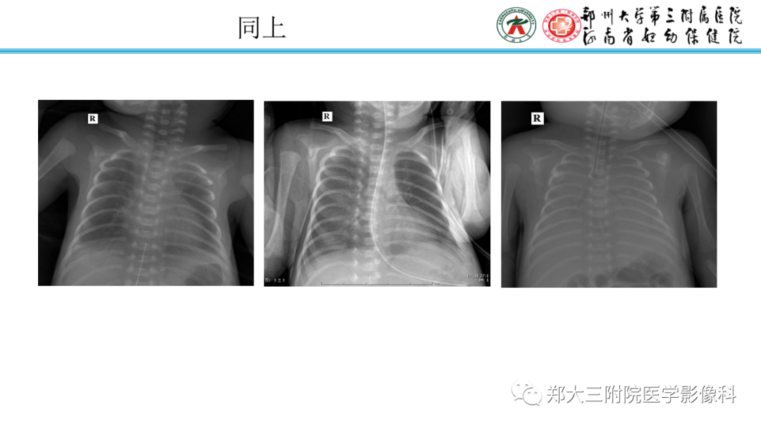 影像PPT - 【PPT】新生儿呼吸窘迫综合征床旁胸片诊断-22